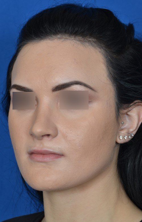 rhinoplasty after
