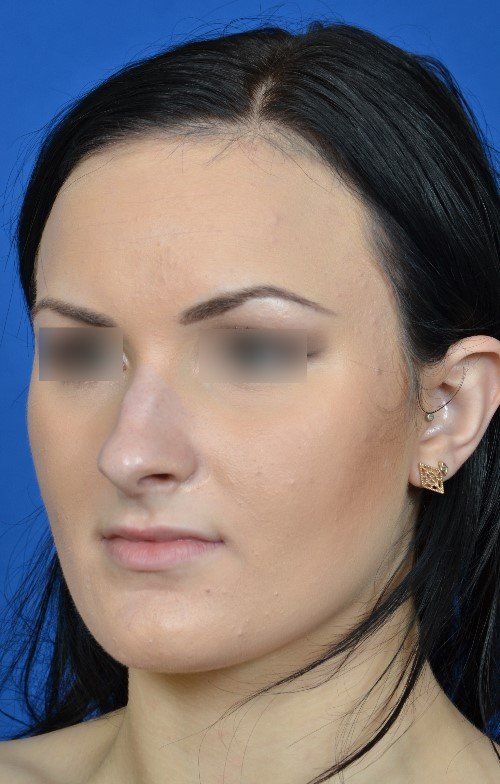 rhinoplasty before