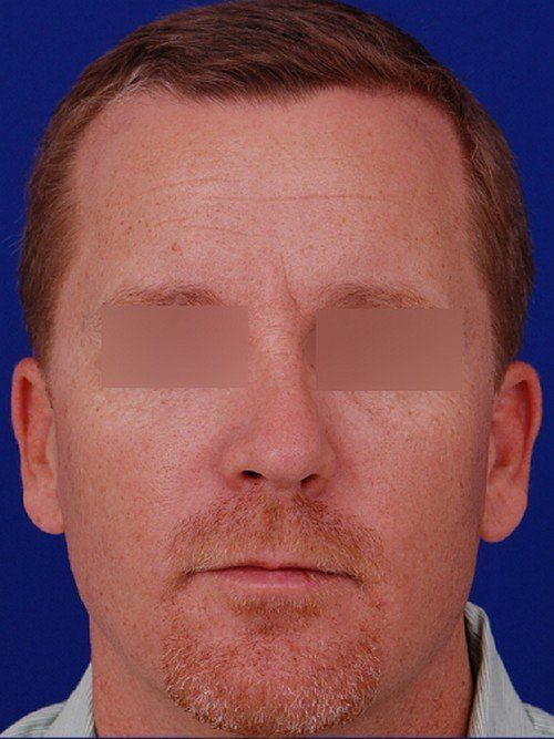 male rhinoplasty