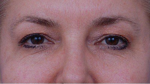 brow lift before and after