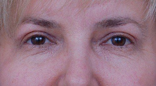 brow lift before and after