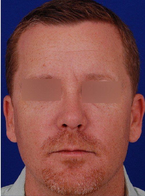 male rhinoplasty after