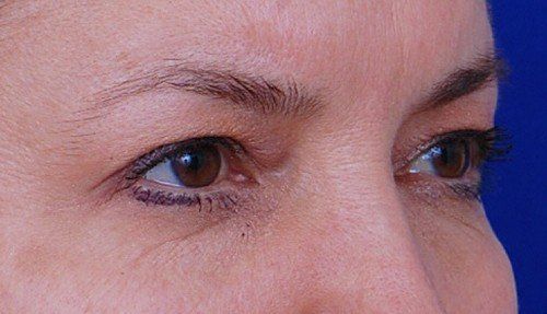 brow lift before and after