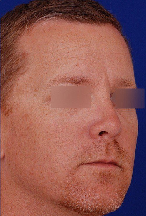 male rhinoplasty