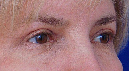 brow lift before and after