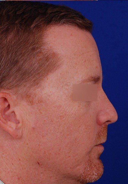male rhinoplasty