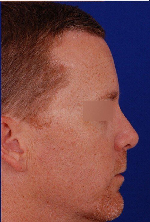 male rhinoplasty after