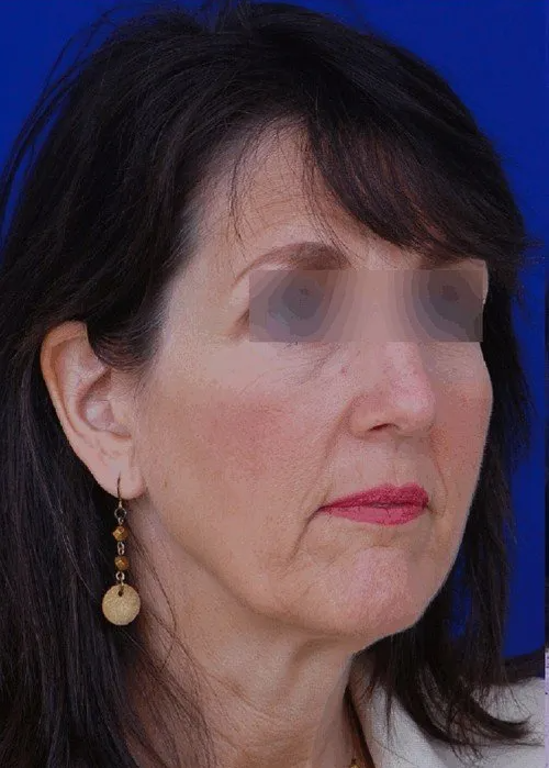 female facelift