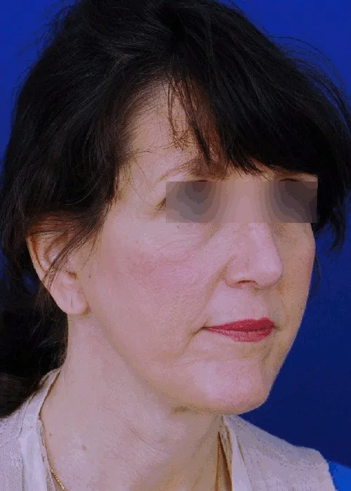 female facelift