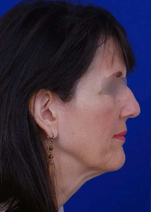 rhinoplasty side view