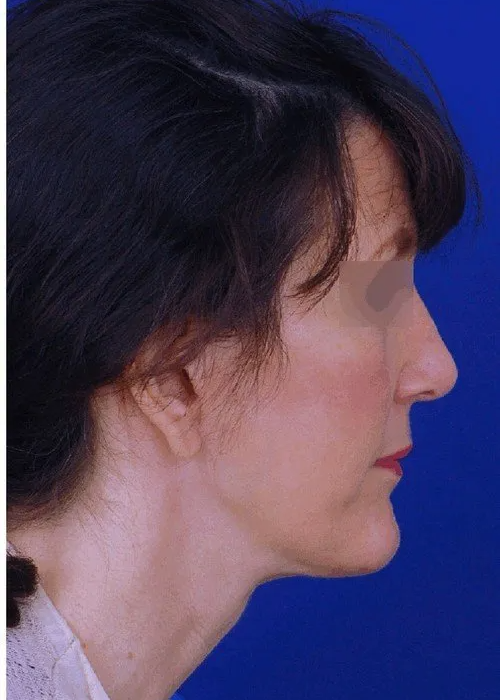 rhinoplasty side view