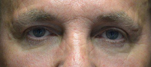 blepharoplasty before and after