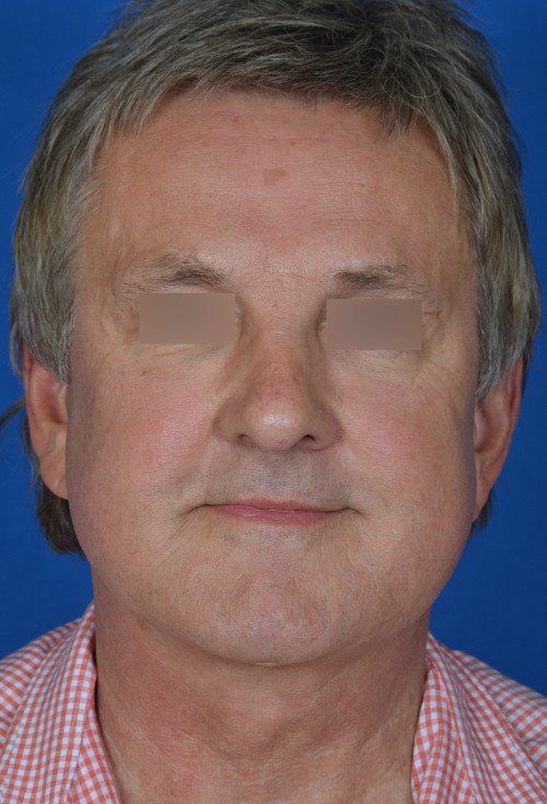 mini facelift before and after