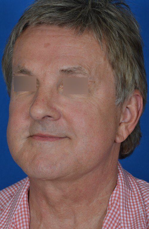 mini facelift before and after