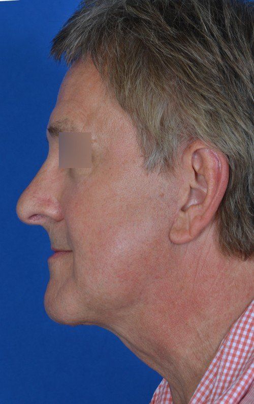 mini facelift before and after