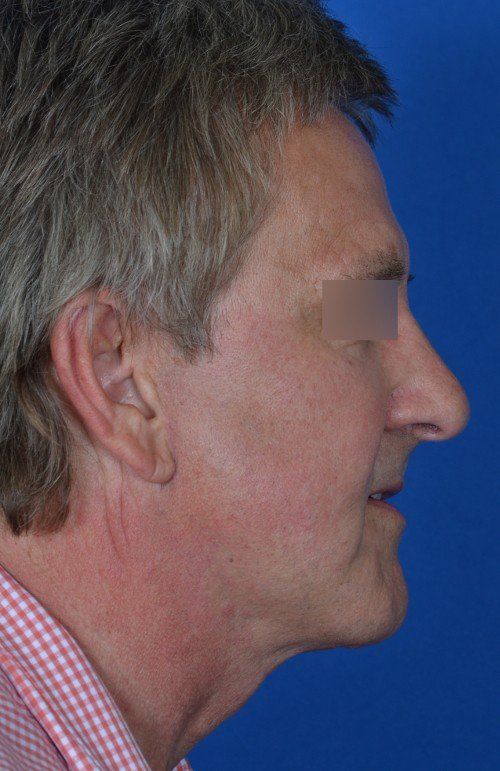 male mini facelift after