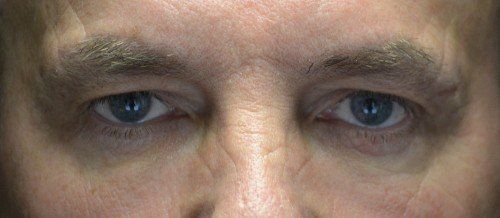 blepharoplasty before and after