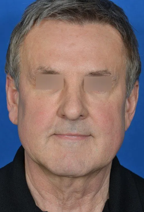 mini facelift before and after