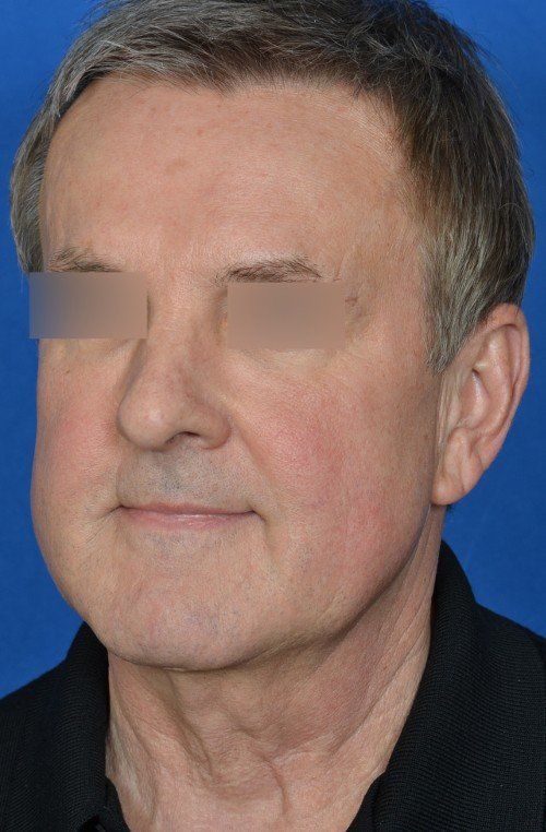 mini facelift before and after