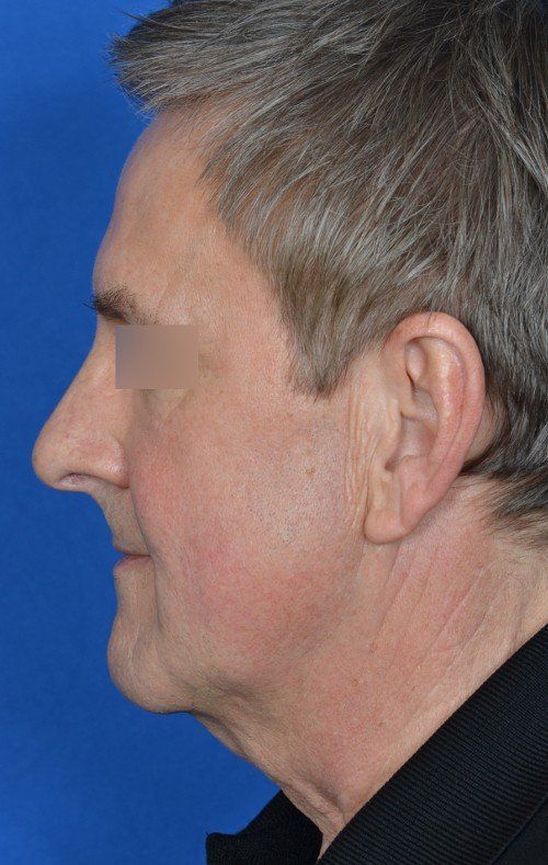 mini facelift before and after