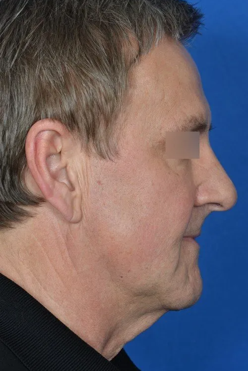 male mini facelift before