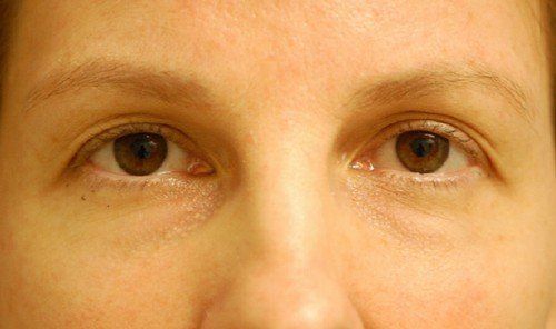 blepharoplasty before and after