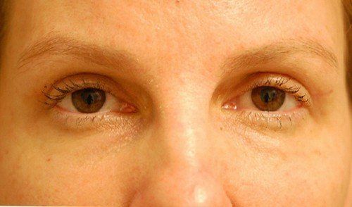 blepharoplasty before and after