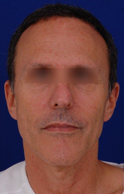mini facelift before and after