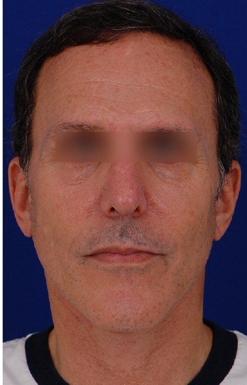 mini facelift before and after