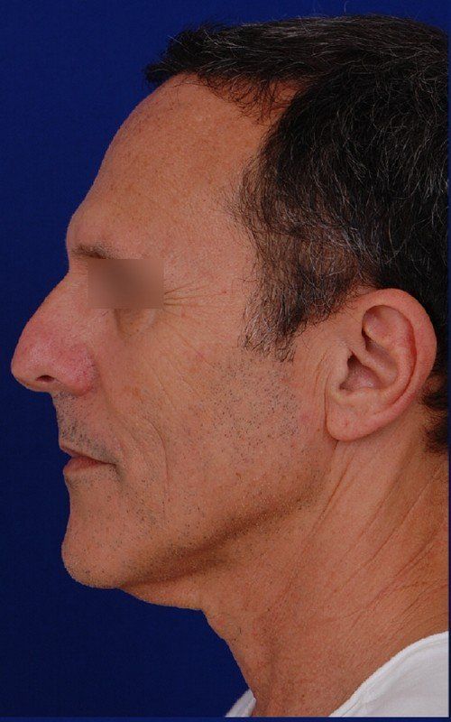 male mini facelift before