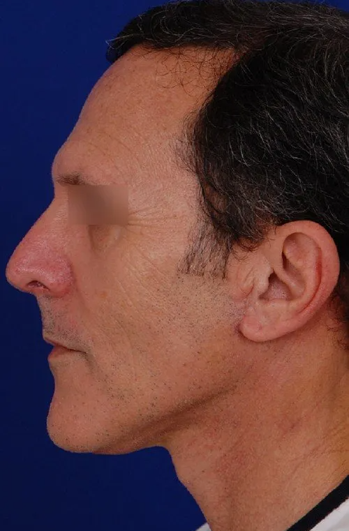male mini facelift after