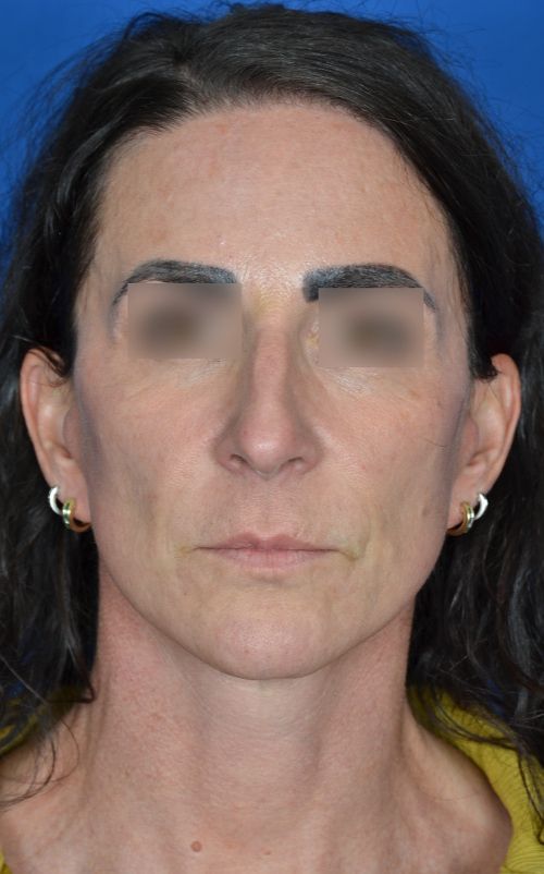 mini facelift before and after