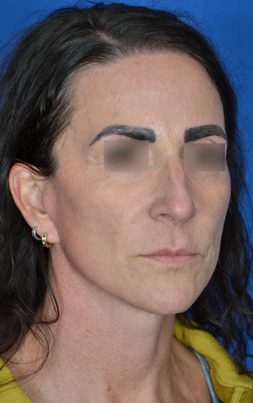 mini facelift before and after