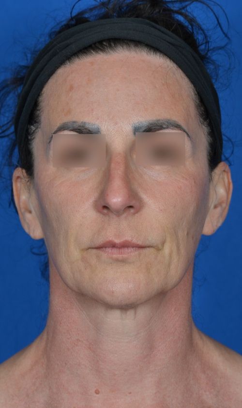 mini facelift before and after