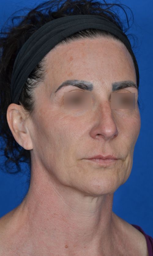 mini facelift bemini facelift before and afterfore and after