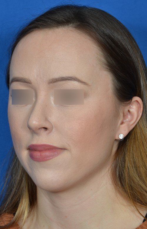female rhinoplasty
