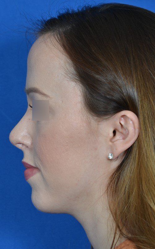 female rhinoplasty