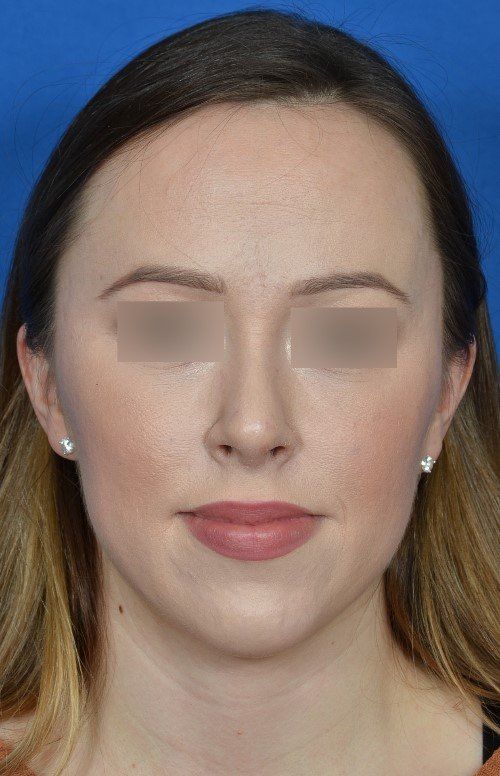 female rhinoplasty