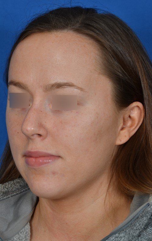 female rhinoplasty
