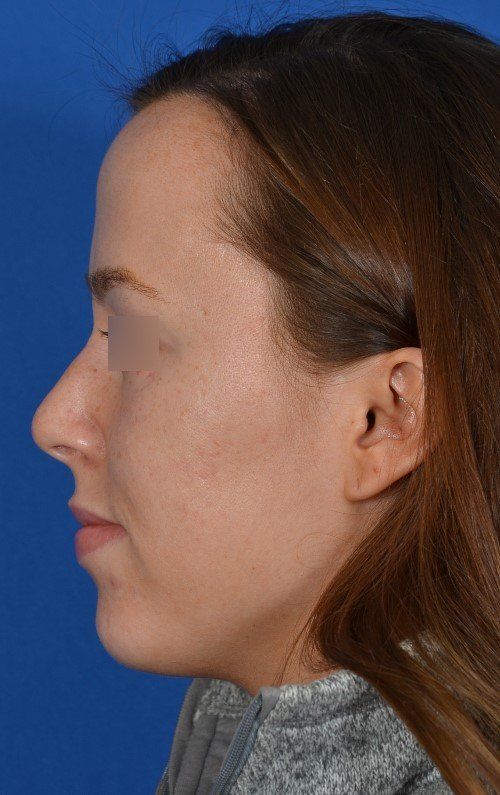 female rhinoplasty