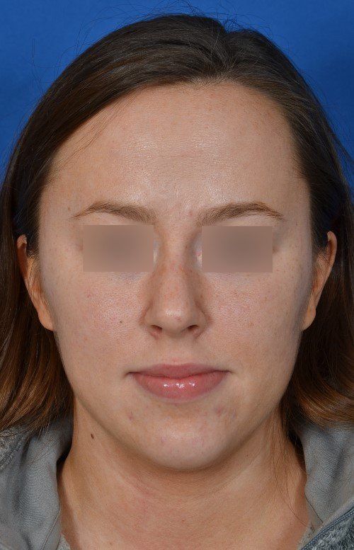 female rhinoplasty