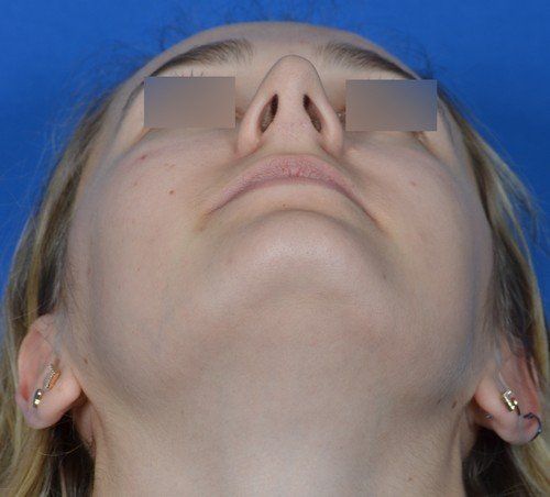 revision rhinoplasty