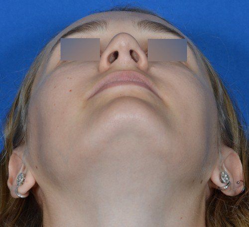 revision rhinoplasty