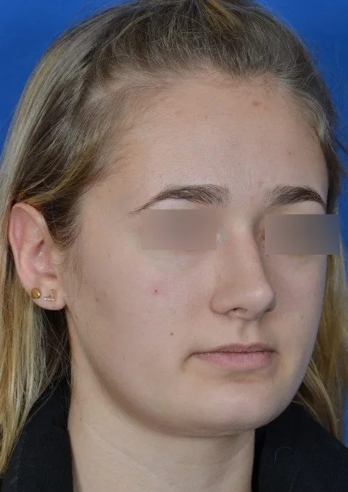 revision rhinoplasty