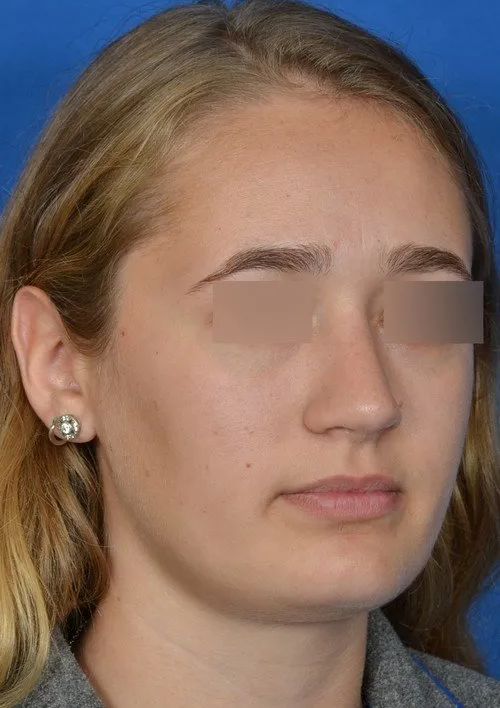 revision rhinoplasty