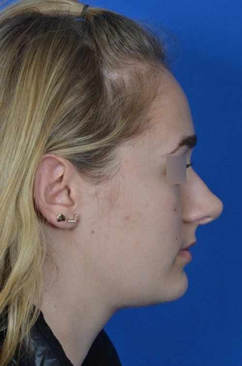 revision rhinoplasty
