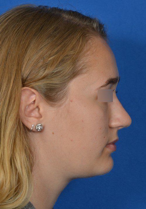 revision rhinoplasty