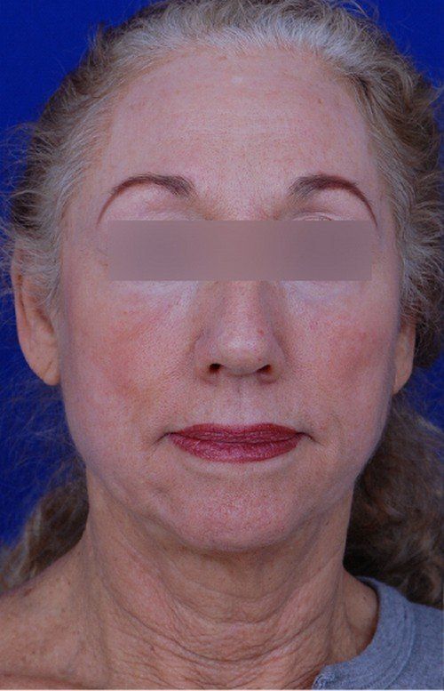 female facelift