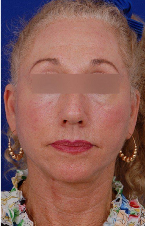 female facelift