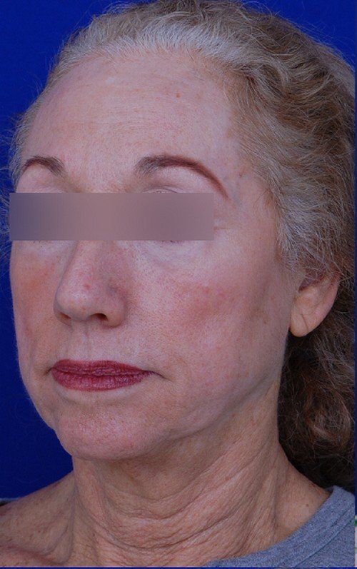 female facelift